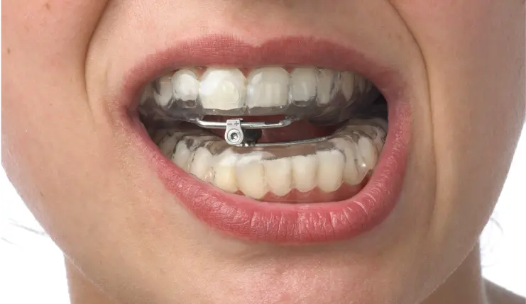 Nahaufnahme eines Mundes mit transparenten Zahnschienen und einer Metallklammer zur Kieferkorrektur