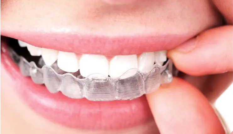 Nahaufnahme einer Person, die eine durchsichtige Zahnschiene an den Zähnen anpasst