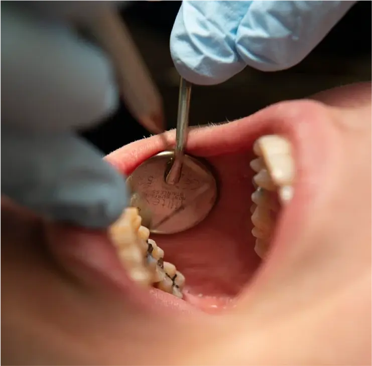 Nahaufnahme einer zahnärztlichen Untersuchung – Einsatz eines Mundspiegels und von Werkzeugen zur Untersuchung der Zähne und Zahnfüllungen