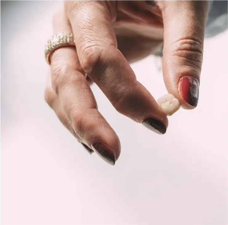 Hand hält eine fertige Zahnfüllung aus Keramik zur Einsetzung im Zahn