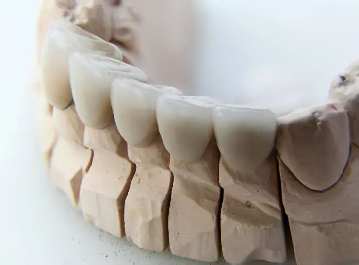 Nahaufnahme eines Zahnmodells mit ästhetischen Zahnkronen. Das Modell zeigt die Detailarbeit und Präzision bei der Herstellung von Zahnersatz für ein natürliches Lächeln.