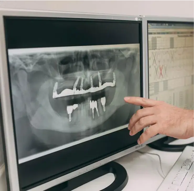 Nahaufnahme eines Röntgenbilds auf einem Monitor, das Zahnimplantate im Unterkiefer zeigt. Ein Zahnarzt zeigt auf die Röntgenaufnahme während der Implantatbehandlungsplanung