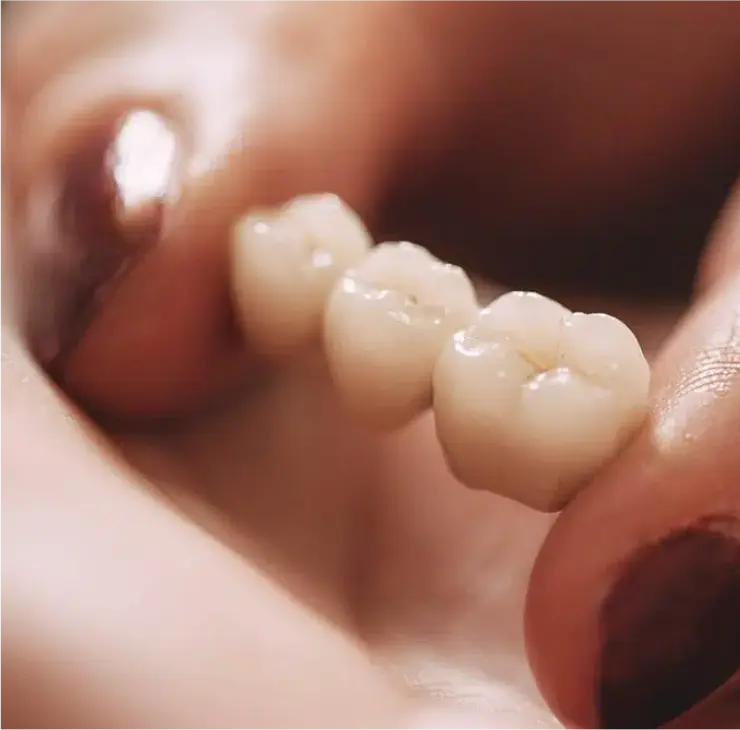 Nahaufnahme einer Zahnbrücke zur Prothetik in der Zahnarztpraxis Sandhofpassage Frankfurt – Hochwertige Zahnersatzlösungen für optimale Ästhetik und Funktion