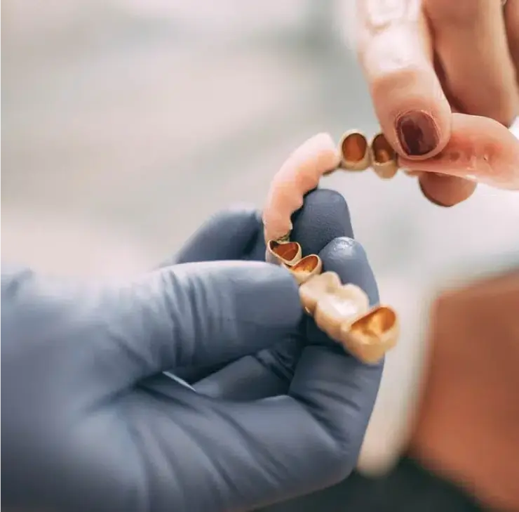 Prothetische Versorgung mit Brücken – Zahnarztpraxis Sandhofpassage Frankfurt. Detailaufnahme einer Zahnbrücke zur Wiederherstellung der Zahnreihe und Kaustabilität.