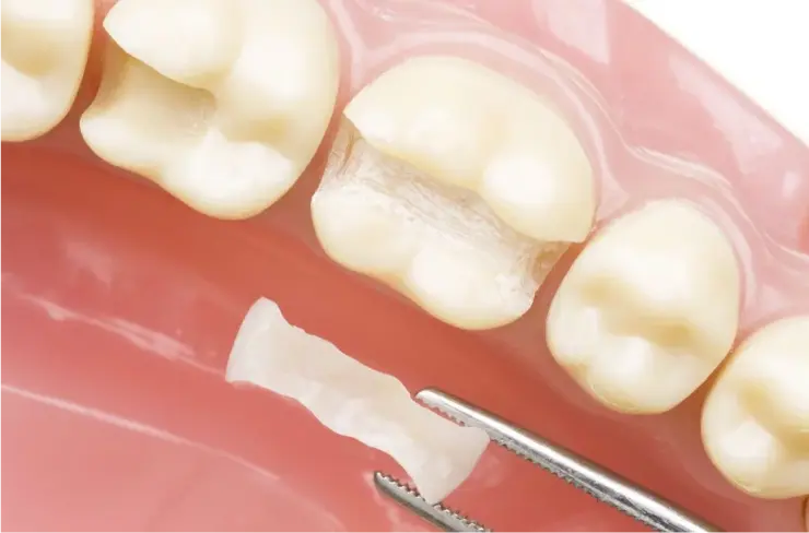 Einsatz einer Zahnprothese bei einer restaurativen Behandlung in der Zahnarztpraxis Sandhofpassage Frankfurt – Prothetik zur Wiederherstellung der Zahnfunktion